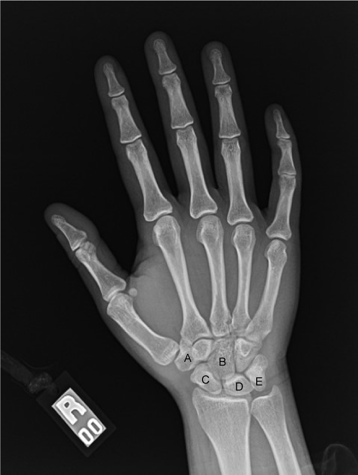 <strong>A 54-year-old woman arrives at the emergency department with a hand injury sustained in a fall. In the restroom, the patient stumbled and fell backwards onto her outstretched right hand. She was able to get up, but she has been experiencing right wrist discomfort and finger numbness since the incident. Obesity, hypertension, and type 2 diabetes mellitus are all present in his medical history. A tiny hump is detected immediately below the palm of her right hand, and there is diminished feeling in the palmar aspect of her first three digits. A dislocation of the lunate resulting in median nerve compression is suspected. On a normal x-ray, which of the following indicated bones is most likely displaced in this patient?  </strong> A)A B)B C)C D)D E)E <div style=padding-top: 35px> 