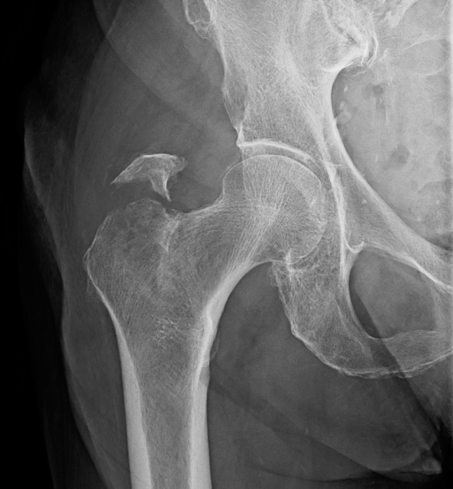 <strong>A 73-year-old woman is brought to the emergency department due to right hip pain.  The patient was getting out of the shower when she slipped and fell directly on her right hip.  She now has pain and swelling over the lateral aspect of her hip and cannot walk without assistance.  Vital signs are within normal limits.  Bilateral pedal pulses are normal, and sensation is intact.  X-ray of the right hip is shown below :   Examination of this patient will most likely show impaired function of which of the following muscles?</strong> A)Adductor magnus B)Gluteus medius C)Iliopsoas D)Rectus femoris E)Sartorius <div style=padding-top: 35px> 