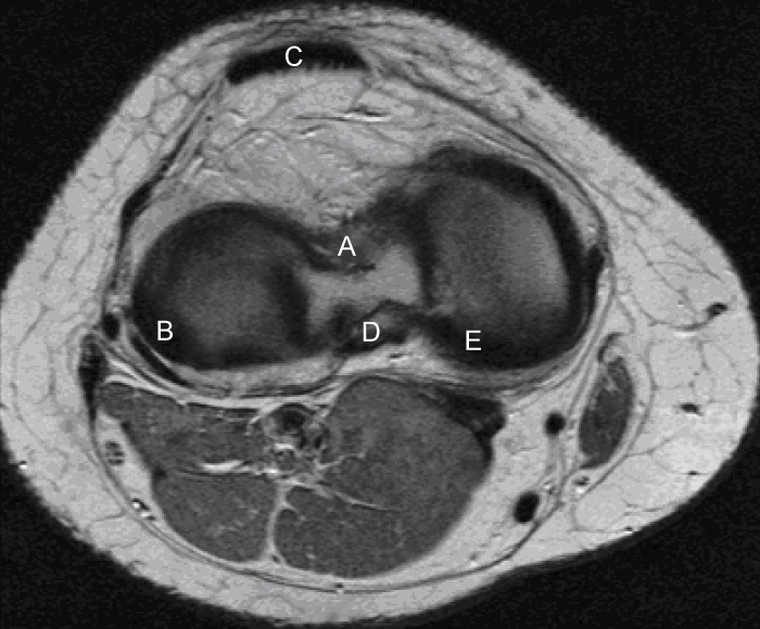 <strong>A 20-year-old man arrives at the hospital complaining of knee discomfort after tripping and landing on his right knee during a soccer game. He has been unable to bear weight since the incident since the anterior area of his tibia struck straight against the ground. The patient's knee seems swollen on physical examination, and there is significant posterior displacement of the tibia when pressure is given to his anterior tibia with the knee flexed. The image below shows an axial MRI cross section of the right knee at the tibial plateau level. Which of the following structures in this patient is most likely injured?  </strong> A)A B)B C)C D)D E)E <div style=padding-top: 35px> 