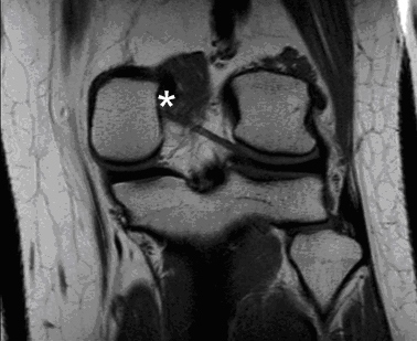 <strong>A 23-year-old basketball player arrives at the office complaining of right knee discomfort. A coronal MRI of his knee, seen from the back, is presented below.   The asterisk marks the attachment site of which of the following ligaments?</strong> A)Anterior cruciate B)Patellar C)Posterior cruciate D)Tibial collateral E)Transverse genicular <div style=padding-top: 35px> 