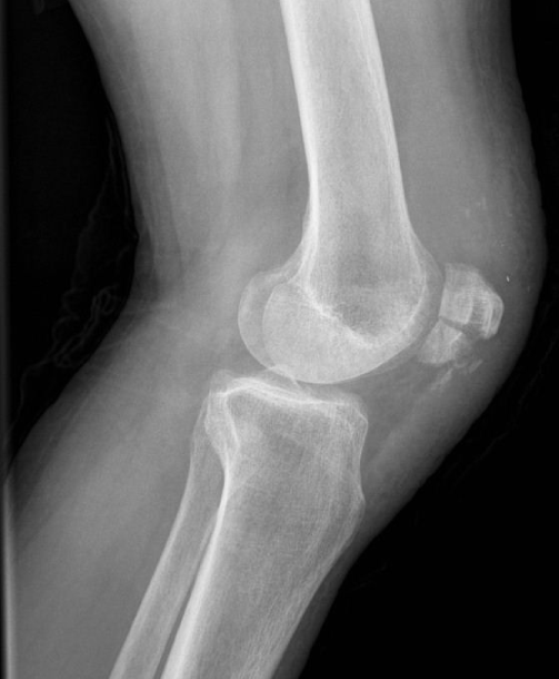 <strong>Following a ground-level fall at home, a 46-year-old woman is transported to the emergency room by ambulance. She slid out of the shower and landed on her left knee on the tile floor. The patient is unable to walk due to acute left knee pain and edema. The examination reveals a knee contusion and soft tissue edema, as well as a substantial knee effusion. The picture below shows an X-ray of the knee:   Which of the following examination findings would most likely be seen in this patient?</strong> A)Backward movement of the tibia against a fixed femur B)Excessive joint widening on valgus stress C)Forward movement of the tibia against a fixed femur D)Inability to extend the knee against gravity E)Inability to flex the knee against resistance <div style=padding-top: 35px> 