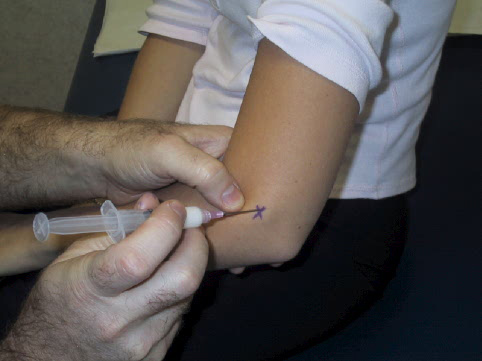 <strong>A 16-year-old girl arrives at the clinic complaining of left elbow discomfort that has been bothering her for several months. The pain worsens with activities, limiting her ability to exercise. She has tried over-the-counter ibuprofen and acetaminophen but has only gotten partial relief. Seasonal allergies are mentioned in the medical history, and current treatments include a fluticasone nasal spray. A further examination reveals that the patient's condition is the result of a tendon damage. A long-acting glucocorticoid injection is given to the most tender area, as seen in the figure below..   Which of the following actions is most likely performed by the affected muscle?</strong> A)Finger adduction B)Forearm flexion C)Shoulder abduction D)Thumb abduction E)Wrist extension F)Wrist flexion <div style=padding-top: 35px> 
