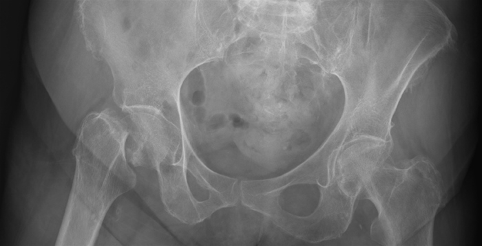 <strong>After a fall, a 68-year-old woman is taken to the emergency department with significant right hip discomfort. She stumbled on a rug and crashed against a wall before falling on her right hip on the floor. There is a history of sadness and polymyalgia rheumatica in the patient. Sertraline and low-dose prednisone are among the medications used. She also has a smoking history of 40 packs per year. The blood pressure is 145/85 mm Hg, and the pulse rate is 96 beats per minute. The patient appeared to be in a lot of agony. She can't move her right hip, and her right leg looks to be shorter than her left. The picture below depicts a pelvic x-ray:   Injury involving which of the following arteries is most likely to lead to osteonecrosis in this patient?</strong> A)Deep femoral B)Inferior gluteal C)Lateral circumflex femoral D)Medial circumflex femoral E)Obturator <div style=padding-top: 35px> 