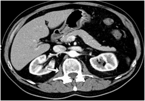 <strong>A 52-year-old man arrives at the hospital after experiencing nonspecific back and stomach discomfort for four weeks. He has also had episodes of fever, anorexia, and a 2-kg (4.4-lb) weight loss. The patient was diagnosed with HIV recently and has not yet started antiretroviral medication. He has a history of using intravenous drugs. An infection involving the structure indicated by the arrow in the figure below is shown by a CT scan of the abdomen.   Which of the following structures is involved by this patient's infectious process?</strong> A)Erector spinae muscle B)Iliacus muscle C)Ligamentum flavum D)Psoas muscle E)Transversus abdominis muscle <div style=padding-top: 35px> 