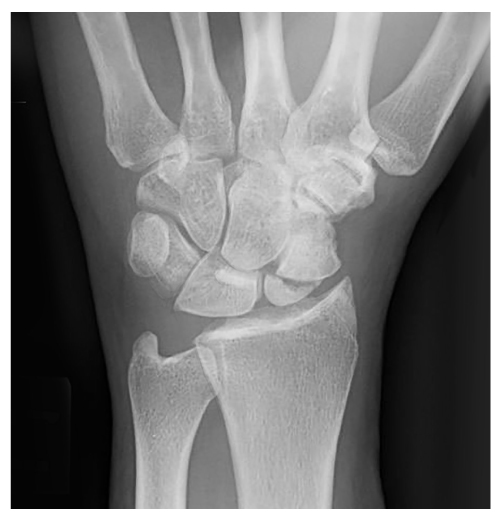 A 56-year-old man comes to the emergency department due to persistent left wrist pain.  While walking his dog 5 hours ago, he fell forward onto the ground and landed on his outstretched hand.  Examination shows mild left wrist swelling with preserved range of motion.  There is point tenderness over the dorsolateral aspect of the wrist between the tendons of the extensor pollicis longus and extensor pollicis brevis.  An x-ray of the left wrist is shown in the image below:   This patient is at greatest risk for developing which of the following complications? A) Avascular necrosis B) Carpal tunnel syndrome C) Compartment syndrome D) Dupuytren contracture E) Guyon canal syndrome
