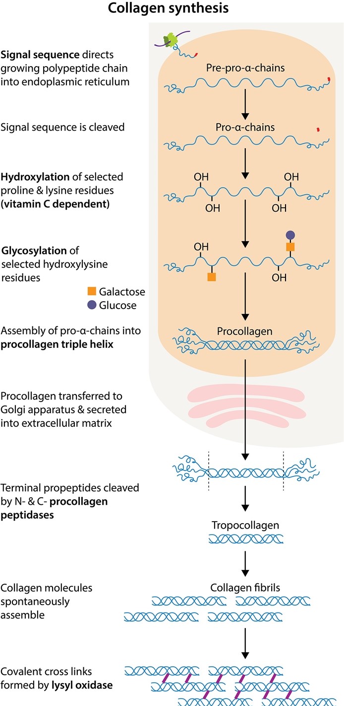 C   This child likely has <strong>Ehlers-Danlos syndrome</strong>, a group of rare hereditary disorders characterized by <strong>defective collagen synthesis</strong>.  The condition can be caused by a <strong>deficiency</strong> in <strong>procollagen peptidase</strong>, the enzyme that cleaves terminal propeptides from procollagen in the extracellular space.  Impaired propeptide removal results in the formation of soluble collagen that does not properly crosslink.  Consequently, patients often have joint laxity, <strong>hyperextensible skin, fragile tissue</strong> with easy bruising, and poor wound healing. Each collagen molecule consists of 3 polypeptide α-chains held together by hydrogen bonds, forming a triple helix.  Collagen assumes this conformation because each of the α-chains has a simple, repetitive amino acid sequence represented as (Gly-X-Y)<sub>n</sub>.  The smallest amino acid, glycine (Gly), is necessary at every third position to ensure compact coiling of the helix.  Many of the amino acids represented by X and Y are proline residues, which kink the polypeptide chain and enhance the rigidity of the helical structure due to their ring configuration. Mature collagen is synthesized by fibroblasts, osteoblasts, and chondroblasts through the following steps: As translation begins in the cytoplasm, an amino acid signal sequence at the N-terminus of the α-chain facilitates ribosomal binding to the rough endoplasmic reticulum (RER) and passage of the growing polypeptide chain (pre-pro-α-chain) into the RER. Inside the RER, the hydrophobic signal sequence is cleaved to yield the pro-α-chain.  Proline and lysine at the Y positions of the pro-α-chain are hydroxylated to hydroxyproline and hydroxylysine, respectively <strong>(Choice D)</strong>.  Glycosylation of select hydroxylysine residues also occurs within the RER <strong>(Choice A)</strong>. The central helical region of the pro-α-chain is flanked by N- and C-terminal propeptides.  Disulfide bond formation between the C-terminal propeptide region of 3 α-chains brings the chains into an alignment favorable for assembly into a triple helix (procollagen molecule) <strong>(Choices B and E)</strong>. Procollagen molecules are then transported through the Golgi apparatus into the extracellular space.  The N- and C-terminal propeptides are cleaved by procollagen peptidases, converting procollagen into less soluble tropocollagen. Tropocollagen monomers self-assemble into collagen fibrils.  Finally, lysyl oxidase helps create covalent crosslinks between collagen fibrils to form strong collagen fibers. <strong>Educational objective:</strong> Ehlers-Danlos syndrome is a group of rare hereditary disorders characterized by defective collagen synthesis.  It can be caused by procollagen peptidase deficiency, which results in impaired cleavage of terminal propeptides in the extracellular space.  Patients often have joint laxity, hyperextensible skin, and tissue fragility due to the formation of soluble collagen that does not properly crosslink. __________ References: Defect in conversion of procollagen to collagen in a form of Ehlers-Danlos syndrome. (http://www.ncbi.nlm.nih.gov/pubmed/4742738) Defects in the biochemistry of collagen in diseases of connective tissue. (http://www.ncbi.nlm.nih.gov/pubmed/1448) Clinical and genetic aspects of Ehlers-Danlos syndrome, classic type. (http://www.ncbi.nlm.nih.gov/pubmed/20847697)
