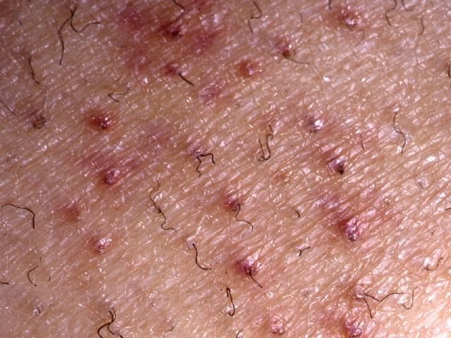 A 78-year-old woman comes to the office due to tenderness and easy bleeding of the gums when she brushes her teeth.  The patient has brushed her teeth twice a day for as long as she can remember and has not experienced these symptoms before.  Physical examination shows swollen gingiva that bleed on probing.  Her skin findings are shown in the image below.   Further questioning reveals that the patient lives alone and that her diet consists primarily of tea and toast.  Her symptoms are most likely caused by hypoactivity of an enzyme found in which of the following compartments? A) Extracellular space B) Golgi apparatus C) Lysosomes D) Mitochondria E) Nucleus F) Rough endoplasmic reticulum