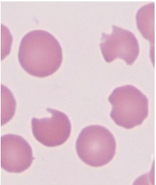 A 24-year-old man is evaluated for episodic anemia, jaundice, and dark urine.  These episodes typically occur after the use of certain drugs or following infection.  Additional history reveals that he has a brother who experiences similar episodes.  Peripheral blood smear reveals red blood cells with the findings shown below.   Deficiency of which of the following enzymes would most likely result in a condition similar to this patient's presentation? A) Bisphosphoglycerate mutase B) Glutathione reductase C) Hexokinase D) Pyruvate kinase E) Transketolase
