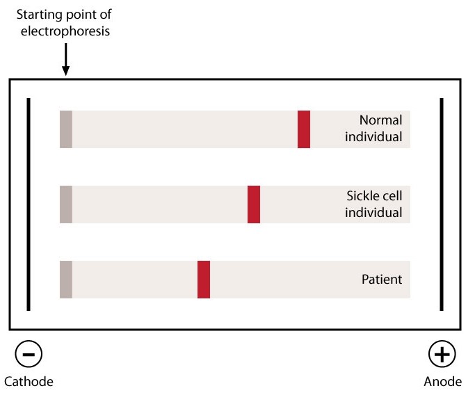 A 6-year-old African American boy is brought to the physician because of easy fatigability.  Physical examination reveals splenomegaly, and his complete blood count shows mild anemia.  Hemoglobin electrophoresis is performed at alkaline pH on a cellulose acetate strip.  Findings for the patient are shown below compared to individuals with normal hemoglobin and known sickle cell disease.   Which of the following is the most likely cause of this patient's condition? A) Alpha globin gene deletion B) Missense mutation C) Nonsense mutation D) Silent mutation E) Trinucleotide expansion