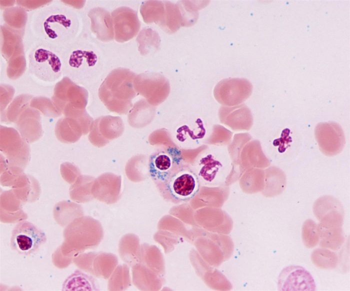 A 40-year-old woman comes to the office with a 3-month history of progressively limited physical activity due to fatigue.  The patient says,  I could barely walk from my car to the office.   Medical history is significant for a positive tuberculin skin test 7 months ago with a normal chest radiograph.  She has been compliant with the prescribed treatment despite its bitter taste.  Physical examination shows a tired-appearing woman with conjunctival and palmar pallor.  Complete blood count is as follows:   A bone marrow aspirate representative of this patient's disease process is shown below (Prussian blue stain) .   Decreased activity of which of the following enzymes most likely explains the anemia found in this patient? A) δ-aminolevulinic acid dehydratase B) δ-aminolevulinic acid synthase C) Cystathionine synthase D) Glucose-6-phosphate dehydrogenase E) Pyruvate kinase