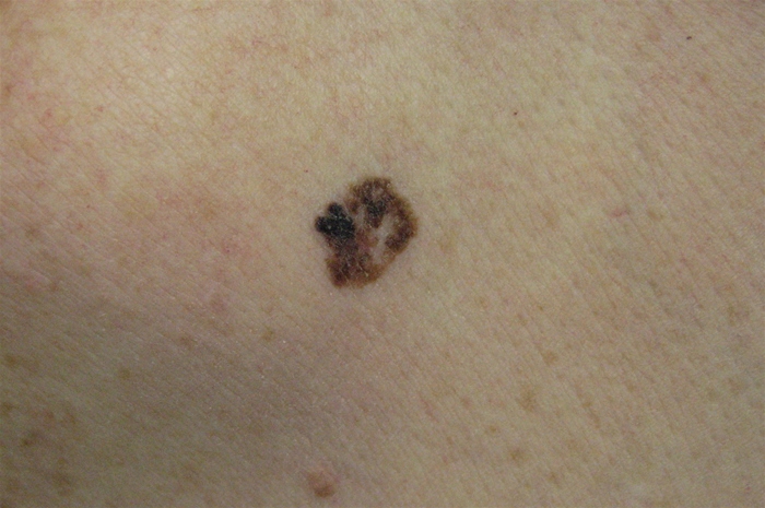 A 45-year-old woman is sent to the emergency room after having a widespread tonic-clonic seizure. She has no past history of seizures, but she has just developed right arm weakness. Her family history is noteworthy since her mother died of skin cancer. Physical examination reveals a 13-mm skin lesion on her back, as illustrated in the photograph below.   This lesion most likely originated from which of the following embryologic derivatives? A) Endoderm B) Mesoderm C) Neural crest D) Neuroectoderm E) Surface ectoderm