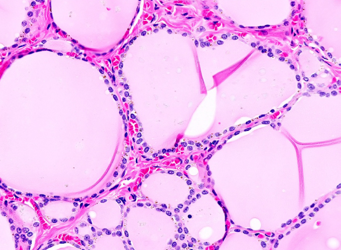 A 13-year-old boy is brought to the clinic due to progressive difficulty with breathing, hoarseness, and dysphagia.  The symptoms began insidiously 6 months ago but have rapidly become worse in the last 4 weeks.  The patient has no associated skin rash, pharyngeal pain, fever, weight loss, or loss of appetite.  Medical history is unremarkable and the patient takes no medications.  He is up to date on scheduled vaccinations.  The patient's parents and siblings have no history of significant health problems.  Vital signs are normal, and he is at 70th percentile for height and weight.  Oropharyngeal examination reveals a large, red lingual mass.  The patient subsequently undergoes excision of the mass; histopathologic preparation of the recovered tissue is shown in the image below.   Failure of which of the following embryologic processes is most likely responsible for this patient's lesion? A) Apoptosis B) Differentiation C) Fusion D) Migration E) Proliferation