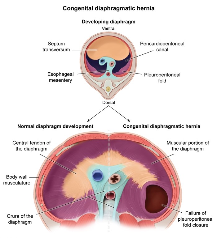 A   This <strong>newborn</strong> with <strong>respiratory distress</strong> and <strong>unilateral decreased breath sounds</strong> has a <strong>scaphoid abdomen</strong> and chest x-ray revealing cystic structures.&nbsp; These findings are consistent with a <strong>congenital diaphragmatic hernia</strong> (CDH), a congenital malformation caused by failure of the pleuroperitoneal folds to close. In general, the diaphragm forms from 4 distinct tissues: the septum transversum, esophageal mesentery, musculature from the body wall, and pleuroperitoneal folds.&nbsp; Extension of the <strong>pleuroperitoneal folds</strong> to these other structures ultimately leads to division of the pericardioperitoneal canal into the peritoneal cavity and thoracic cavity.&nbsp; <strong>Failure of closure</strong> results in an abnormal communication between the thorax and abdomen.&nbsp; This defect is usually located on the left posterolateral side, allowing bowel, stomach, spleen, and/or liver to herniate into the thorax.&nbsp; Because this malformation occurs during organogenesis in the first trimester, compression of the developing lung leads to <strong>pulmonary hypoplasia</strong>. Affected newborns have respiratory distress at birth.&nbsp; Displacement of abdominal organs into the thorax causes the abdomen to appear scaphoid and the chest barrel shaped.&nbsp; Ipsilateral breath sounds are decreased or absent.&nbsp; Chest x-ray findings supportive of CDH include <strong>mediastinal shift</strong> and <strong>thoracic bowel loops</strong>, which may appear as cystic, fluid-filled structures. <strong>(Choice B)</strong>&nbsp; Failure of ventral body wall closure results in gastroschisis, which is characterized by bowel evisceration without a protective membrane.&nbsp; A full-thickness abdominal wall defect is apparent on examination. <strong>(Choice C)</strong>&nbsp; The pleuropericardial membranes, which become the fibrous pericardium, fuse to separate the pericardial and pleural cavities.&nbsp; Fusion defects are rare, often asymptomatic, and result in communication between these two thoracic cavities, not between the thorax and abdomen. <strong>(Choice D)</strong>&nbsp; Malrotation, characterized by incomplete physiologic rotation of the bowel in utero, usually presents with bilious emesis in infancy due to duodenal obstruction from abnormally positioned peritoneal bands.&nbsp; Respiratory distress and thoracic bowel loops would not be seen. <strong>(Choice E)</strong>&nbsp; Abnormal separation of the dorsal (gastrointestinal tract) and ventral (respiratory tract) foregut results in esophageal atresia with or without a tracheoesophageal fistula.&nbsp; Symptoms include respiratory distress and choking with feeds; chest x-ray would not show cystic thoracic structures. <strong>Educational objective:</strong> Congenital diaphragmatic hernia is caused by failure of the pleuroperitoneal folds to close.&nbsp; Immediately after birth, newborns have respiratory distress, unilateral decreased breath sounds, and a scaphoid abdomen, with imaging revealing thoracic bowel loops and mediastinal shift. __________ References: Congenital diaphragmatic hernia. (http://www.ncbi.nlm.nih.gov/pubmed/32310536) Congenital diaphragmatic hernia-a review. (http://www.ncbi.nlm.nih.gov/pubmed/28331629)