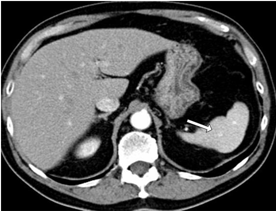 A 23-year-old man comes to the office with a 2-week history of malaise, loss of appetite, and vague abdominal pain.  The patient has had no nausea, vomiting, changes in his bowel habits, dysuria, urinary frequency, or hematuria.  He had an appendectomy for acute appendicitis at age 15; his medical history is otherwise unremarkable.  He does not use tobacco or alcohol and has had no recent travel.  His father was diagnosed with colon cancer at age 60.  Physical examination reveals normal bowel sounds and no guarding or rebound tenderness.  Abdominal CT scan obtained as part of this patient's evaluation is shown in the image below.   The anatomical structure indicated by the arrow originates from which of the following embryologic divisions? A) Ectoderm B) Endoderm C) Mesoderm D) Neural crest E) Notochord