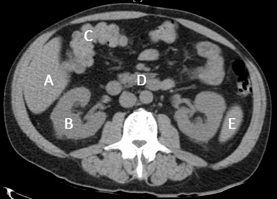 A 35-year-old man comes to the emergency department due to persistent abdominal pain.  Yesterday, during a soccer game, he suffered a full-speed collision with another player.  He had diffuse abdominal pain at the time but did not seek care until this morning, when the pain seemed to worsen.  As part of the patient's evaluation, a CT scan of the abdomen is obtained and shown in the image below.  It is determined that his injury involves an organ that is supplied mainly by an artery of the foregut even though the organ itself is not a foregut derivative.  Which of the following organs is most likely to be injured in this patient?   A) A B) B C) C D) D E) E
