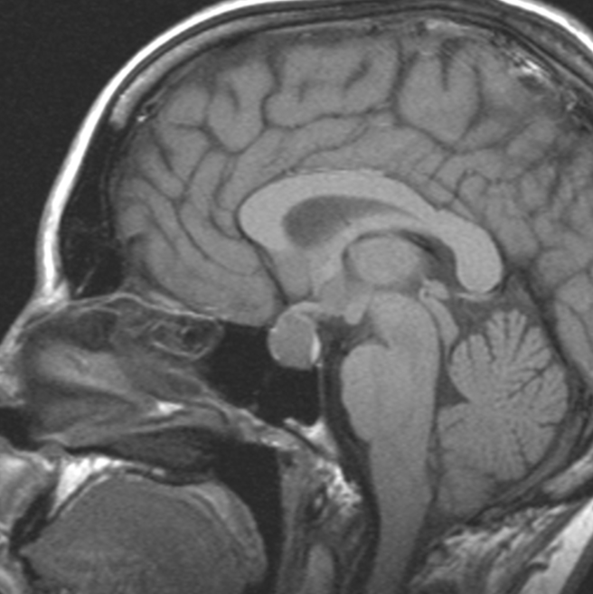 After a car accident, a 38-year-old woman is taken to the emergency room. She was not hurt in the crash, but she insists she did not notice the automobile that hit her along the front side of her vehicle. The patient also reported experiencing everyday migraines and not having menstruated in 4 months. There is bitemporal hemianopsia but no other abnormalities on physical examination. A brain MRI is depicted below.   This patient's lesion most likely originates from which of the following embryologic layers? A) Endoderm B) Mesoderm C) Neural crest D) Neural tube E) Notochord F) Surface ectoderm