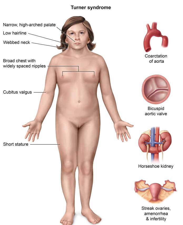 C   <strong>Primary amenorrhea</strong> is defined as the absence of menses by age 15 in someone who has normal growth and secondary sexual characteristics (eg, body hair growth, breast development) or absence of menses by age 13 in girls without secondary sex characteristics.  Chromosomal abnormalities resulting in ovarian insufficiency are the most common cause of primary amenorrhea. This patient's short stature, high arched palate, Tanner I breasts, and widely spaced nipples are characteristic of <strong>Turner syndrome (45,XO)</strong>.  Patients with Turner syndrome have a variable degree of <strong>ovarian dysgenesis</strong>.  The ovaries usually appear underdeveloped and atrophic (streak gonads) due to in utero degeneration of the ovarian follicles with replacement by fibrotic tissue.  Since menstruation and breast development are estrogen-dependent processes, they do not occur because the ovaries are nonfunctional. <strong>(Choice A)</strong>  Although patients with Turner syndrome may have streak ovaries, the uterus should be present.  An absent uterus and primary amenorrhea can be seen in Müllerian agenesis and androgen insensitivity syndrome. <strong>(Choice B)</strong>  Turner syndrome patients have normal female external genitalia.  Ambiguous external genitalia can be seen in 46,XX patients with congenital adrenal hyperplasia. <strong>(Choice D)</strong>  Fibrotic fallopian tubes are not seen in Turner syndrome but are sometimes seen in pelvic inflammatory disease. <strong>(Choice E)</strong>  Hirsutism and secondary amenorrhea can be seen in polycystic ovarian syndrome. <strong>(Choice F)</strong>  Vaginal agenesis results from absence or underdevelopment of the Müllerian ductal system (Müllerian agenesis).  Although patients with Müllerian agenesis have primary amenorrhea, they will have normal palate and breast development. <strong>Educational objective:</strong> Common manifestations of Turner syndrome include primary amenorrhea, short stature, a high arched palate, and widely spaced nipples.  Primary amenorrhea occurs in these patients due to in utero degeneration of the ovarian follicles (gonadal dysgenesis). __________ References: The patient with Turner syndrome: puberty and medical management concerns. (http://www.ncbi.nlm.nih.gov/pubmed/22884020)