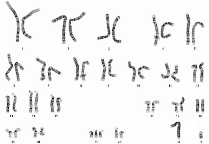 <strong>A 35-year-old woman, gravida 1 para 0, at 20 weeks gestation comes to the office for a routine prenatal visit and fetal anatomy ultrasound.  The ultrasound reveals several abnormalities.  An amniocentesis is performed and a fetal karyotype analysis is ordered; the results are shown in the image below:   This fetus is at greatest risk for developing which of the following conditions after birth?</strong> A)Acute lymphoblastic leukemia B)Aplastic anemia C)Chronic myelogenous leukemia D)Germ cell tumor E)Retinoblastoma F)Rhabdomyosarcoma <div style=padding-top: 35px> 