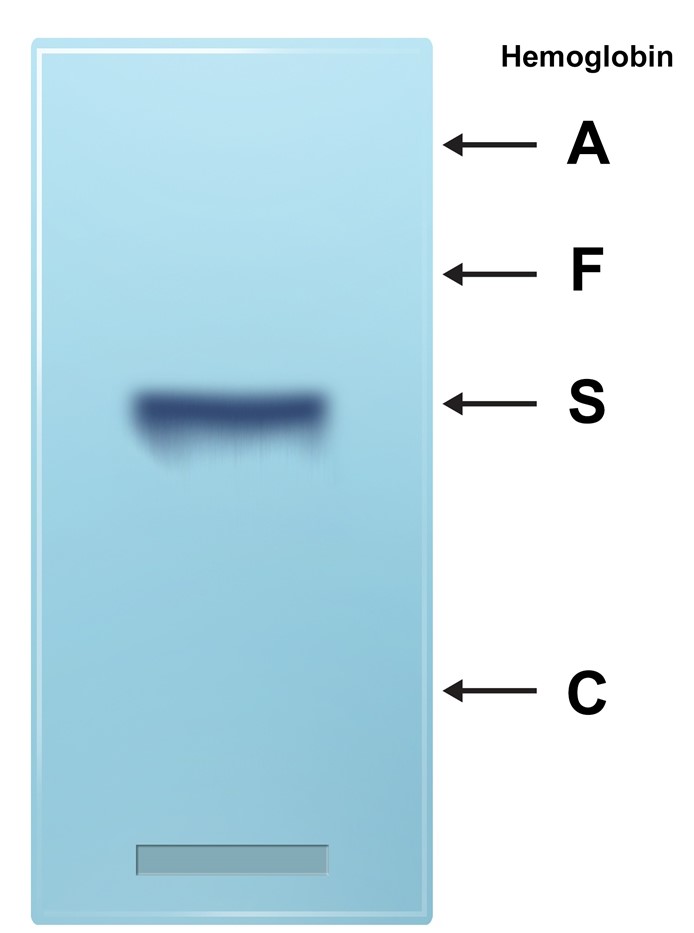 <strong>A 26-year-old woman comes to the office with her husband for genetic counseling.  She is pregnant with their second child, whose gender is unknown.  Both parents are asymptomatic, but their firstborn 3-year-old son has recurrent episodes of anemia, jaundice, and painful swelling of the hands and feet.  A blood sample is obtained from the boy, and hemoglobin electrophoresis is performed at alkaline pH.  The results are shown in the image below.   What is the probability that the unborn child will inherit one or more mutant alleles from the parents?</strong> A)Near 0 B)25% C)50% D)75% E)100% <div style=padding-top: 35px> 