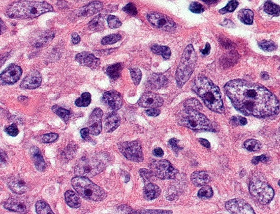A 58-year-old man comes to the office with a persistent dry cough.  He has experienced an involuntary weight loss of 10 kg (22 lb)  over the last 3 months.  The patient drinks 2-3 beers daily and has a 40-pack-year smoking history.  Physical examination shows dullness to percussion over the right lower lung base.  A chest CT reveals a right-sided pleural effusion and a mass in the lower lobe of the right lung.  Transbronchial biopsy of the mass demonstrates malignant cells with large nuclei that contain prominent, round, basophilic bodies as shown below.   Which of the following enzymes is most likely to function only within this basophilic region of the nucleus? A) DNA endonuclease B) DNA polymerase C) RNA polymerase I D) RNA polymerase II E) RNA polymerase III