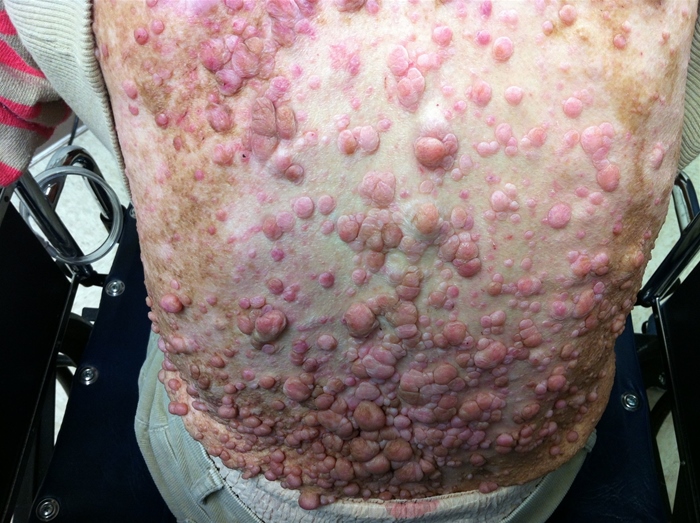 A 54-year-old man comes to the physician with recent-onset mild headaches and left leg weakness.  The lesions seen on physical examination are shown in the image below.   Which of the following inheritance patterns is this patient's disorder most likely to exhibit? A) Genomic imprinting B) Mitochondrial C) Multifactorial D) Single-gene autosomal dominant E) Single-gene autosomal recessive F) Single-gene X-linked