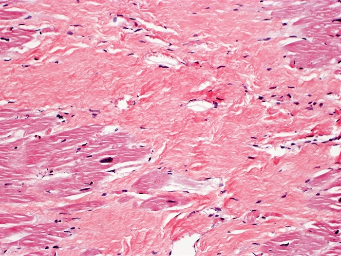 <strong>A 67-year-old man has been discovered dead in his house. The reason of death is unknown; he had a history of hypertension and had a myocardial infarction a year before. An autopsy is carried out. A physical examination of the heart reveals white scarring and left ventricle enlargement. Below are histologic results from a portion of the left ventricle.   The type of collagen seen in the autopsy sample is most likely to be extensively found in which of the following normal body tissues?</strong> A)Basement membrane B)Granulation tissue C)Hyaline cartilage D)Nucleus pulposus E)Tendon <div style=padding-top: 35px> 