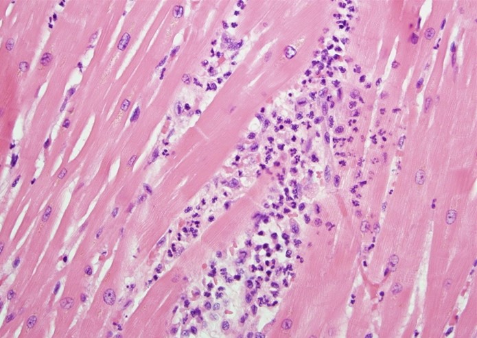 An autopsy is being performed on a 72-year-old man with a history of myocardial infarction.  Light microscopy of a portion of the left ventricle reveals the findings shown in the image below:   This patient most likely sustained the myocardial infarction during which of the following time frames prior to his death? A) Less than 4 hours B) 1 to 3 days C) 7 to 10 days D) 2 weeks to 2 months E) More than 2 months