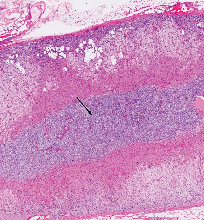 A researcher is looking at the elements that influence adrenal hormone production and release. A donor cadaver's intact adrenal gland is acquired, and a histologic slice across the complete gland is shown below. Cells are collected from a specific region of the gland, indicated by the arrow, for further examination.   These cells are most likely to be directly activated by which of the following substances? A) Acetylcholine B) ACTH C) Angiotensin II D) Epinephrine E) Norepinephrine