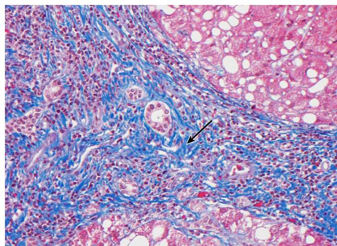 A 62-year-old man arrives at the office for a jaundice evaluation. Medical history is important in the case of uncontrolled type 2 diabetes and morbid obesity. He does not smoke, drink, or use illegal drugs. There is no history of liver illness in the family. The vital indicators are within normal ranges. The average BMI is 47 kg/m<sup>2</sup>. There is mild scleral icterus. Normal heart and lung sounds The abdomen is not painful or swollen. There is some bilateral lower extremities edema. Transaminases are shown to be increased in laboratory tests. A liver biopsy is performed, and trichrome staining reveals:   Which of the following cells is directly responsible for the histologic finding indicated by the arrow? A) Cholangiocytes B) Hepatocytes C) Kupffer cells D) Sinusoidal endothelial cells E) Stellate (Ito)  cells