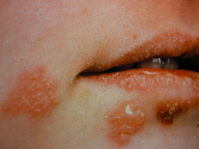 <strong>A 20-year-old woman arrives at the office with blisters around her lips and a minor burning sensation. She reports regular recurrences of similar lesions, which disappear spontaneously within a few days. She has no medical issues and is not on any drugs. The results of the physical examination are depicted in the figure below.   The causal organism of this patient's disease is found to be dormant in the neuronal cell bodies of sensory ganglia. When the virus is reactivated, it travels to the skin through the nerve axon. Which of the following proteins is most likely involved in the disease recurrence transport process?</strong> A)Dynein B)Kinesin C)Lamin D)Selectin E)Spectrin F)Vimentin <div style=padding-top: 35px> 
