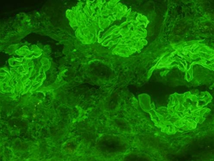 <strong>A 43-year-old man arrives to the office complaining of shortness of breath and exhaustion. His weariness has been so severe over the previous two weeks that he has little energy, even to get out of bed. The patient has no chills but has recently gained weight and had ankle edema. He has no previous medical issues and does not use any drugs. The blood pressure is 168/94 mm Hg, and the pulse rate is 95 beats per minute. The patient has bilateral pitting edema of the lower extremities that is localized to the ankles. Urinalysis showed 2+ protein, 5-7 white blood cell count/hpf, and 75-100 red blood cell count/hpf. He had a kidney biopsy, and the results of immunofluorescent microscopy are displayed in the figure below.   Which of the following would be the most likely finding on light microscopy in this patient?</strong> A)Amyloid deposition B)Crescent formation C)Diffuse capillary wall thickening D)Nodular glomerulosclerosis E)Normal glomeruli <div style=padding-top: 35px> 