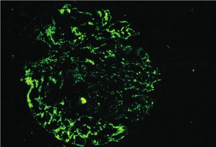 Due to severe face puffiness, an 8-year-old child is brought to the doctor. His mother adds that he has been easily exhausted and has had black urine for the previous 24 hours. The patient had a skin infection three weeks ago and has no chronic medical issues. The temperature is 36.1 degrees Celsius (97 degrees Fahrenheit) , and the blood pressure is 140/94 mm Hg. Periorbital edema and moderate pitting edema around the ankles are seen on physical examination. The rest of the test reveals no abnormalities. The picture below depicts a representative kidney biopsy sample.   The fluorescent areas on the slide most likely indicate the presence of which of the following substances? A) Albumin B) C1q C) C3 D) Fibrin E) IgE F) M protein
