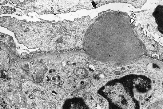 <strong>A 9-year-old child is brought to the office after experiencing facial and ocular puffiness for two days. About three weeks ago, the patient had antibiotic treatment for a rash on her leg. The temperature is 37.2 degrees Celsius (99 degrees Fahrenheit), and the blood pressure is 150/90 mm Hg. There is widespread edema but no rash on physical examination. Proteinuria and hematuria are shown by urinalysis. The following electron microscope picture represents this patient's illness process:   The area marked by the white arrow most likely represents which of the following?</strong> A)Albumin leakage B)Eosinophil enzymes C)Fibrin deposition D)Hyaline accumulation E)Immune complex deposits F)Lipid droplet G)Neutrophil enzymes <div style=padding-top: 35px> 