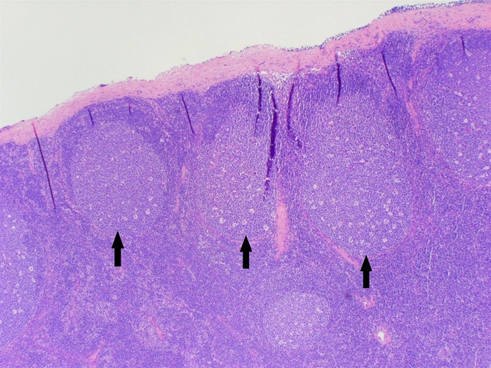 <strong>An 8-year-old boy is brought to the pediatrician with fever, runny nose, and malaise.  After examining the child, the pediatrician determines that he has a viral infection and does not require any specific treatment.  The mother asks why an antibiotic is not necessary, and the physician explains the differences between bacterial and viral infections.  The immune system is composed of both cellular and humoral components, which are able to mount an effective response against many types of viral and bacterial infections.  A section of a normal lymph node is shown in the image below.   The structures indicated by the arrows are most likely to contain cells undergoing which of the following processes?</strong> A)Isotype switching B)Negative selection C)Tolerance development D)VDJ recombination E)VJ recombination <div style=padding-top: 35px> 