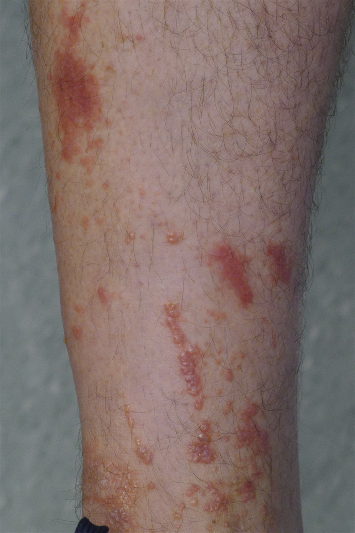 <strong>A 34-year-old electric company worker comes to the physician with a skin rash on his right leg.  He has not eaten any new foods or changed detergents, soaps, or lotions.  On further questioning, the patient recalls that he recently worked on a repair job in an unmaintained, wooded area.  He had atopic dermatitis as a child but no other significant illnesses.  On physical examination, he appears uncomfortable and is constantly scratching his leg.  His lungs are clear bilaterally and his heart sounds are normal.  Examination of his right leg shows the findings in the image below.   Which of the following cells is most responsible for causing the tissue damage seen in this patient?</strong> A)Basophils B)Eosinophils C)Mast cells D)Neutrophils E)Plasma cells F)T lymphocytes <div style=padding-top: 35px> 