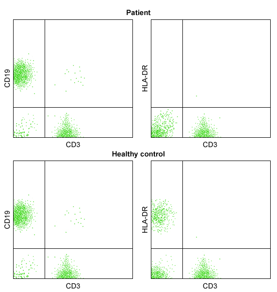 <strong>A 10-month-old boy is hospitalized for respiratory distress due to Pneumocystis jiroveci pneumonia.  The patient has had repeated episodes of otitis media and thrush; weight is below the 5th percentile.  Laboratory evaluation reveals normal levels of circulating B and T cells with low levels of all immunoglobulins.  Genetic testing reveals a rare autosomal recessive mutation resulting in a defect in the regulation of human leukocyte antigen gene transcription.  Flow cytometry of the patient's peripheral blood compared with a healthy control is shown in the illustration below:   Which of the following processes is most likely to be impaired by this patient's mutation?</strong> A)Development of pharyngeal pouches B)Capability of activated CD4<sup>+</sup> T cells to express CD40L C)Maturation of pro-B cells into pre-B cells D)Presentation of antigens processed in lysosomes E)Transport of cytosolic proteins into the endoplasmic reticulum <div style=padding-top: 35px> 