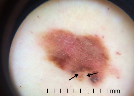 <strong>A 50-year-old lady visits the office to have a mole on her back evaluated. The mole has been there for some years, but her daughter is concerned that it has recently expanded in size. The patient has no significant medical issues, however he was sunburned frequently as a youngster. The picture below depicts a dermoscopic inspection of the lesion.   The lesion has multiple color variations, including dark brown, pink, red, and whitish areas.  Excisional biopsy of the lesion is performed.  The whitish areas (arrows) seen on histologic examination most likely represent which of the following underlying processes?</strong> A)Intense inflammation B)Melanocyte regression C)Proliferating, neoplastic melanocytes D)Proliferating, nonneoplastic melanocytes E)Vessel ectasia <div style=padding-top: 35px> 
