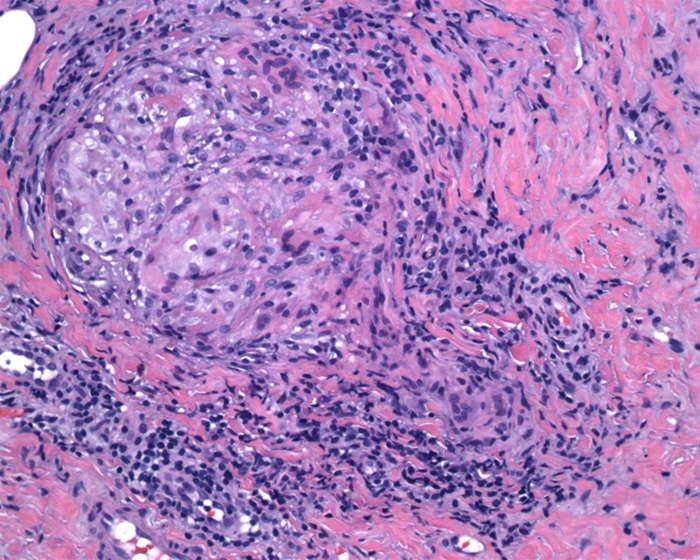 <strong>A 19-year-old man arrives to the office complaining of a painful subcutaneous forearm nodule. He had stitches done two weeks previously after suffering a cut on his left forearm while playing soccer. The lesion is biopsied, and the results are presented below:   Which of the following is most likely responsible for this patient's condition?</strong> A)Excess granulation tissue formation B)Malignant transformation C)Normal wound remodeling D)Persistent neutrophil activity E)Reaction to a foreign body <div style=padding-top: 35px> 