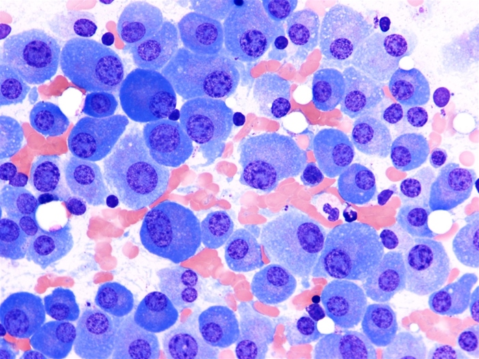 <strong>A 68-year-old woman arrives at the clinic after suffering from recurrent bacterial sinusitis, pneumonia, and urinary tract infections for several months. There are no preexisting medical issues or a history of serious illnesses in infancy for the patient. She does not smoke, drink, or use illegal drugs. The temperature is 36.6 C (97.9 F), the blood pressure is 130/76 mm Hg, and the pulse rate is 72 beats per minute. The lungs are clear to auscultation, the heart sounds are normal, and the belly is soft and nontender with no hepatosplenomegaly on physical examination. Laboratory results show normocytic normochromic anemia. As demonstrated here, a bone marrow aspirate has an increased number of cells.   Which of the following is the most likely cause of this patient's increased susceptibility to infections?</strong> A)Aberrant lysosomal transport and fusion in leukocytes B)Decreased production of functional immunoglobulins C)Defective adhesion and transmigration of leukocytes D)Impaired formation of membrane attack complex E)Impaired phagocytic ability to generate superoxide <div style=padding-top: 35px> 