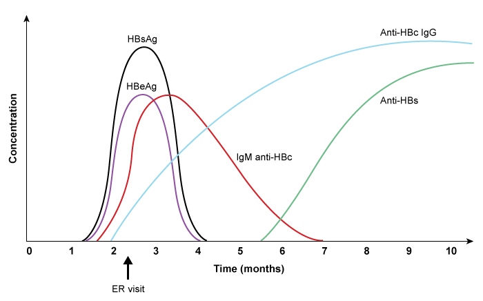 A 23-year-old man arrives to the emergency department after suffering from fever and malaise for 7 days. He has also experienced nausea and a loss of appetite. The patient has no substantial medical history, but he utilizes injectable medications on a daily basis and has had several sexual partners. The temperature is 38 degrees Celsius (100.4 F) . Scleral icterus is discovered during a physical examination. 4 cm below the right costal border, a sensitive, smooth liver edge is perceptible. The appropriate treatment is started. The graph below depicts the evolution of this patient's hepatitis B serologic markers over time.   Which of the following best explains these observed findings? A) Acute hepatitis B that progressed to chronic hepatitis with high infectivity B) Acute hepatitis B that progressed to chronic hepatitis with low infectivity C) Acute exacerbation of pre-existing chronic hepatitis B infection D) Immunity against hepatitis B acquired from vaccination during the hospitalization E) Recovery from acute hepatitis B infection with immunity against reinfection