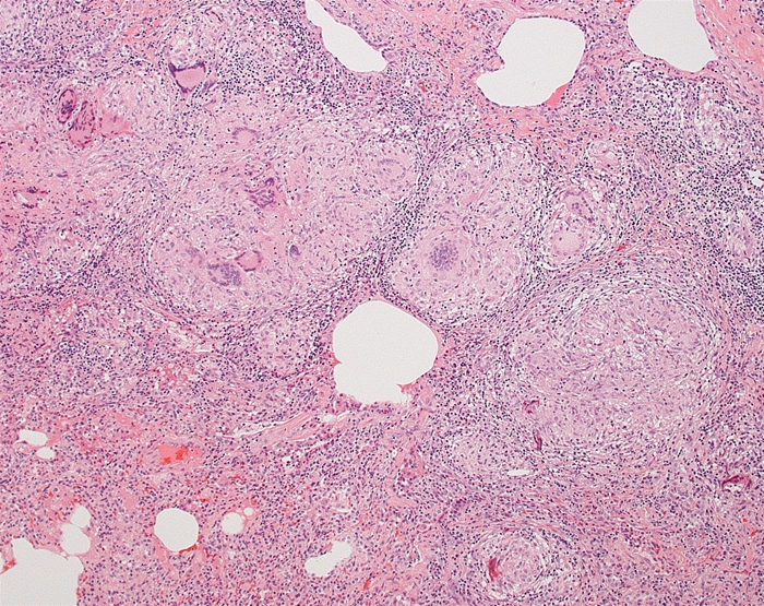 A 37-year-old woman is evaluated for progressive shortness of breath and dry cough.  The patient has seasonal allergies and takes no medications.  There is no significant family history.  On physical examination, the lungs are clear to auscultation.  Chest imaging studies reveal pulmonary infiltrates and hilar adenopathy.  The patient undergoes lung biopsy; the findings are shown below.   Which of the following sets of immune cells and cytokines is most likely responsible for the development of this patient's pathologic findings? A) Th1, IL-2, interferon-γ B) Th1, IL-5, IL-10 C) Th2, IL-3, interferon-γ D) Th2, IL-4, IL-5 E) Th2, IL-5, tumor necrosis factor-alpha