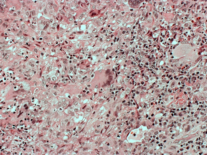 <strong>A 64-year-old man visits the clinic after experiencing many weeks of continuous coughing, fever, and weight loss. He smokes a pack of cigarettes every day and consumes 10 to 12 beers on weekends. An infiltration in the left upper lobe is shown by a chest x-ray. Despite receiving broad-spectrum antibiotic therapy for both aspiration and community-acquired pneumonia, the patient's symptoms deteriorate. The Gram stain on sputum does not indicate any microbes. The following picture depicts the results of a lung biopsy:   Which of the following substances is most important for driving the development of this patient's observed microscopic lesion?</strong> A)C3a B)Fibroblast growth factor C)Granulocyte-macrophage colony-stimulating factor D)IL-4 E)Interferon-alpha F)Interferon-gamma <div style=padding-top: 35px> 