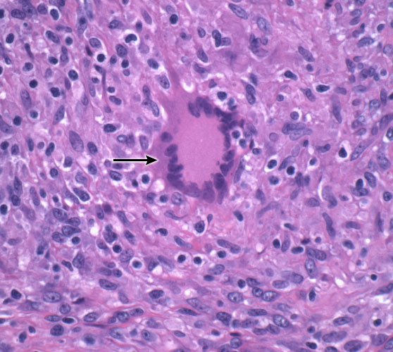 A 44-year-old man with a chronic cough and progressive weight loss comes to the emergency department.  He has lost 5 kg (11 lb)  over the past 3 months.  The patient recently emigrated from Southeast Asia.  Temperature is 37.4 C (99.3 F) , blood pressure is 113/70 mm Hg, pulse is 78/min, and respirations are 18/min.  Chest x-ray reveals an apical left lung infiltrate.  Sputum Gram stain and cultures are negative.  However, culture of a lung biopsy specimen grows acid-fast bacilli.  Microscopy of the lung specimen is shown below.   Which of the following processes is most likely to contribute to formation of the finding indicated by the arrow? A) Activation of CD8 T lymphocytes B) B-lymphocyte transformation C) Fibroblast proliferation D) Neutrophil infiltration E) Cytokine secretion by CD4 T lymphocytes