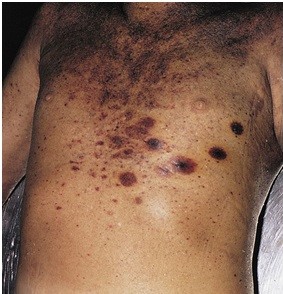 A 55-year-old man comes to the emergency department with fever and chills.  He has a history of acute myeloid leukemia for which he is receiving chemotherapy.  His temperature is 38.3 C (101 F) , blood pressure is 90/50 mm Hg, pulse is 124/min, and respirations are 22/min.  Physical examination is notable for multiple skin patches with necrotic centers and occasional ulcerations, as shown in the image below.   Laboratory results are as follows:   Blood cultures are drawn.  Which of the following organisms is most likely responsible for this patient's symptoms? A) Escherichia coli B) Haemophilus influenzae C) Klebsiella pneumoniae D) Pseudomonas aeruginosa E) Streptococcus pneumoniae F) Streptococcus pyogenes