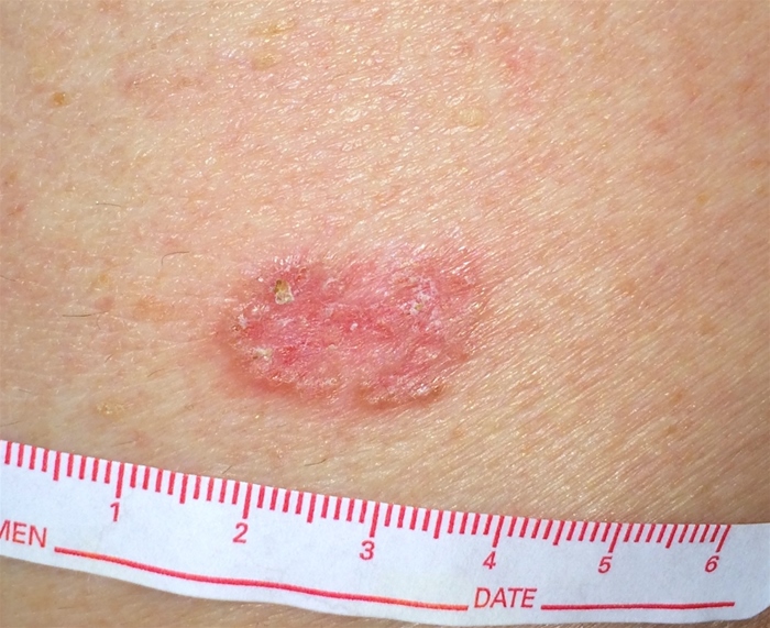 <strong>A 38-year-old woman comes to the office for evaluation of a skin lesion. It began as a pink papule on her right arm and has progressively enlarged over several weeks. The lesion is not pruritic or painful and has not been associated with fever or other systemic symptoms. The patient returned from a trip to Costa Rica 5 weeks ago. During her travel, she stayed at a beachside resort and hiked in the rainforest. Skin examination findings are shown below. Biopsy of the lesion reveals intracellular, round-oval protozoa with rod-shaped kinetoplasts. Which of the following most likely led to this patient's current condition? </strong> A)Bite from infected sand fly B)Contact with infected person C)Exposure to decaying vegetation D)Handling of infected animal E)Swimming in contaminated water