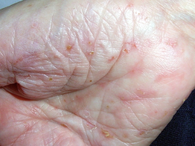 <strong>A 60-year-old woman comes to the physician with 10 days of diffuse itching.  A rash began on her hands and quickly spread to involve her wrists, arms, and axillae.  She has difficulty sleeping and complains of intense itching in these areas.  She works in a day care center and primarily takes care of children age 2-5.  The patient has no other medical conditions and takes no chronic medications.  Vital signs are normal.  Her BMI is 24 kg/m<sup>2</sup>.  Skin examination shows small erythematous papules on the palms with excoriations, scattered vesicles, and pustules on the finger webs, palms, and wrist creases, as seen in the image below.  She has similar lesions in her axillary skin folds bilaterally.  The remainder of the examination is within normal limits.   Which of the following is the most likely finding on skin sampling of this patient's lesions?</strong> A)Budding yeast B)Molluscum bodies C)Multinucleated giant cells D)Necrotic keratinocytes in the epidermis E)Sarcoptes scabiei mite and eggs <div style=padding-top: 35px> 
