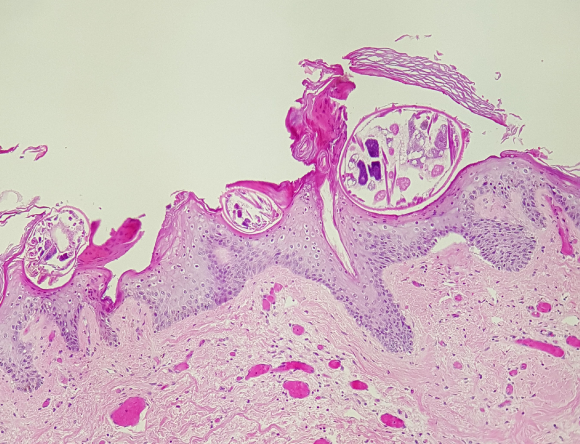 A 29-year-old man is evaluated for a skin rash involving his hands, feet, and scalp for the last 2 weeks.  The rash is mildly pruritic and has progressively worsened.  The patient has a history of HIV and is not adherent with antiretroviral therapy.  Skin examination shows erythematous patches with scales and crusting.  Biopsy of the rash shows organisms burrowed in the epidermis, as shown below:   Which of the following is the most appropriate treatment for this patient? A) Systemic acyclovir B) Systemic terbinafine C) Topical glucocorticoid D) Topical mupirocin E) Topical permethrin