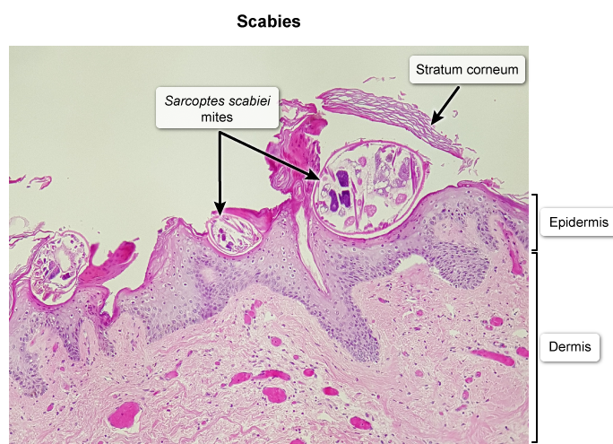 E   <strong>Scabies</strong> is a skin infection caused by the <strong>human itch mite</strong>, Sarcoptes scabiei.  Transmission occurs from prolonged skin-to-skin contact with an infected individual but may occasionally occur due to contact with contaminated fomites (eg, bedsheets, clothing).  Mites <strong>burrow under the epidermis</strong> and evoke a delayed-type hypersensitivity reaction to mite feces and eggs, which leads to an intensely <strong>pruritic rash</strong>.  The mites can often be seen on microscopy. Classic scabies is associated with a mild mite burden (10-15 mites).  Patients usually have several small erythematous papules on the sides/webs of the fingers, wrists, elbows, axillae, waist, and genitalia.  <strong>Excoriations </strong>and <strong>burrows</strong> (thin, serpiginous red tracks) may be seen.  In contrast, patients with impaired cell-mediated immunity (eg, <strong>HIV</strong>) are unable to contain the infection and usually develop crusted scabies, which is associated with thousands or <strong>millions of mites</strong>.  These patients often have mild pruritis (because the inflammatory response is muted) and several erythematous patches with scaling and crusting. Treatment is required to prevent discomfort, transmission, and potential complications (eg, secondary bacterial infection).  First-line therapy includes <strong>topical permethrin</strong>, which blocks mite neurotransmission by impairing voltage-gated sodium channels.  Oral <strong>ivermectin</strong>, an antiparasitic agent that binds chloride ion channels in invertebrate nerve and muscle cells, is an alternate medication for classic scabies that is used in combination with permethrin for crusted scabies. <strong>(Choice A)</strong>  Oral acyclovir is used for human herpes simplex virus outbreaks, which are usually characterized by vesicular lesions on an erythematous base.  The orolabial mucosa and genital area are affected most commonly.  Histopathology would show epidermal blisters with acantholysis and multinucleated cells. <strong>(Choice B)</strong>  Oral terbinafine can be used for patients with dermatophytic infections of the skin.  Dermatophytes often cause an erythematous scaly rash and erosions.  Microscopy typically reveals fungal spores and/or hyphae. <strong>(Choice C)</strong>  Psoriasis is a chronic inflammatory skin condition that can be treated with topical glucocorticoids.  It is usually associated with symmetric, sharply defined skin plaques with overlying scales on the extensor elbows, knees, and scalp.  Microscopy generally shows uniform epidermal hyperplasia, parakeratosis, dilated capillaries in the papillary dermis, and perivascular lymphocytes. <strong>(Choice D)</strong>  Topical mupirocin is used for the treatment of impetigo, a superficial bacterial infection caused by Staphylococcus aureus and Streptococcus pyogenes.  The condition typically presents as a localized papulovesicular rash with surrounding erythema and adherent golden crusts involving the face or extremities. <strong>Educational objective:</strong> Scabies is a human mite infection associated with a pruritic papular rash with excoriations and burrows.  Patients with impaired cell-mediated immunity (eg, HIV) often develop a very high mite burden.  Treatment with topical permethrin and/or ivermectin is generally curative.