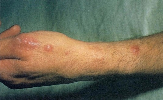<strong>A 46-year-old man comes to the office due to skin lesions that developed on his left arm over the past few days.  The lesions are not particularly painful.  The patient has never had similar symptoms.  He has had no fevers and otherwise feels fine.  Past medical history is insignificant.  The patient takes no medications and has no allergies.  Temperature is 37.1 C (98.8 F).  The lesions are shown in the image below.   Following pathologic sampling, the lesions are determined to be fungal in etiology.  Which of the following scenarios is most likely a component of this patient's history?</strong> A)Animal contact B)Bat guano exposure C)Exposure to seawater D)Immune system disease E)Recent antibiotic use F)Thorn prick <div style=padding-top: 35px> 