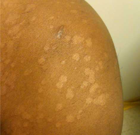 <strong>A 36-year-old man comes to the office to discuss a skin rash on his shoulders and upper chest.  The patient first noticed the rash 2 months ago while vacationing at a beach resort.  The rash has worsened progressively and is associated with mild pruritus, but he has no other associated symptoms.  The patient is a road construction worker, and often works in hot, humid areas.  Past medical history is notable for seasonal allergies and childhood asthma.  He does not use tobacco or alcohol.  Skin examination findings are shown in the image below.   Which of the following is the most likely cause of this patient's condition?</strong> A)Blastomyces dermatitidis B)Candida albicans C)Histoplasma capsulatum D)Malassezia globosa E)Microsporum canis F)Rhizopus species G)Sporothrix schenckii <div style=padding-top: 35px> 